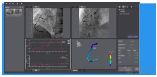 三證齊發(fā),脈流科技心腦血管病功能學(xué)評估產(chǎn)品獲nmpa認(rèn)證